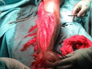 Fasciotomy to relieve compartment syndrome