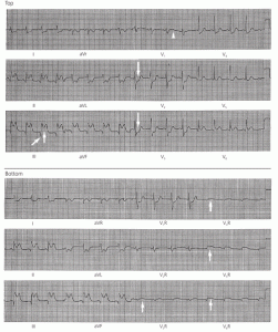 inferior STEMI